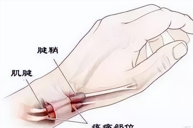 产后三个月手腕筋疼能恢复吗,产前产后手腕疼痛怎么回事