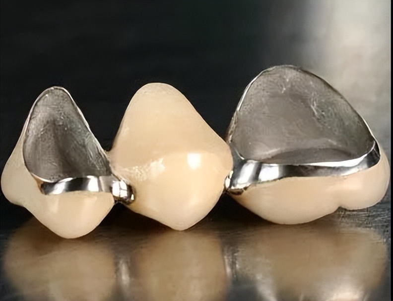 全瓷牙和烤瓷牙如何选择,金属烤瓷牙和全瓷牙