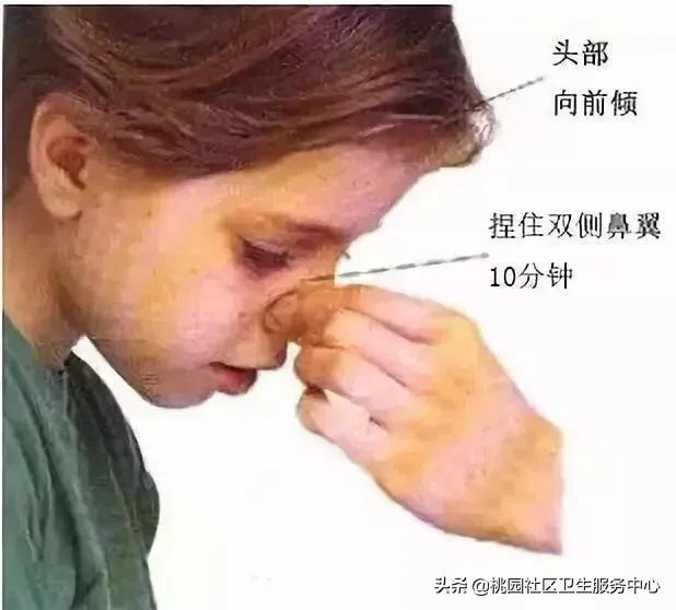 人民医院鼻出血的处理办法,五官科如何诊疗鼻子出血的