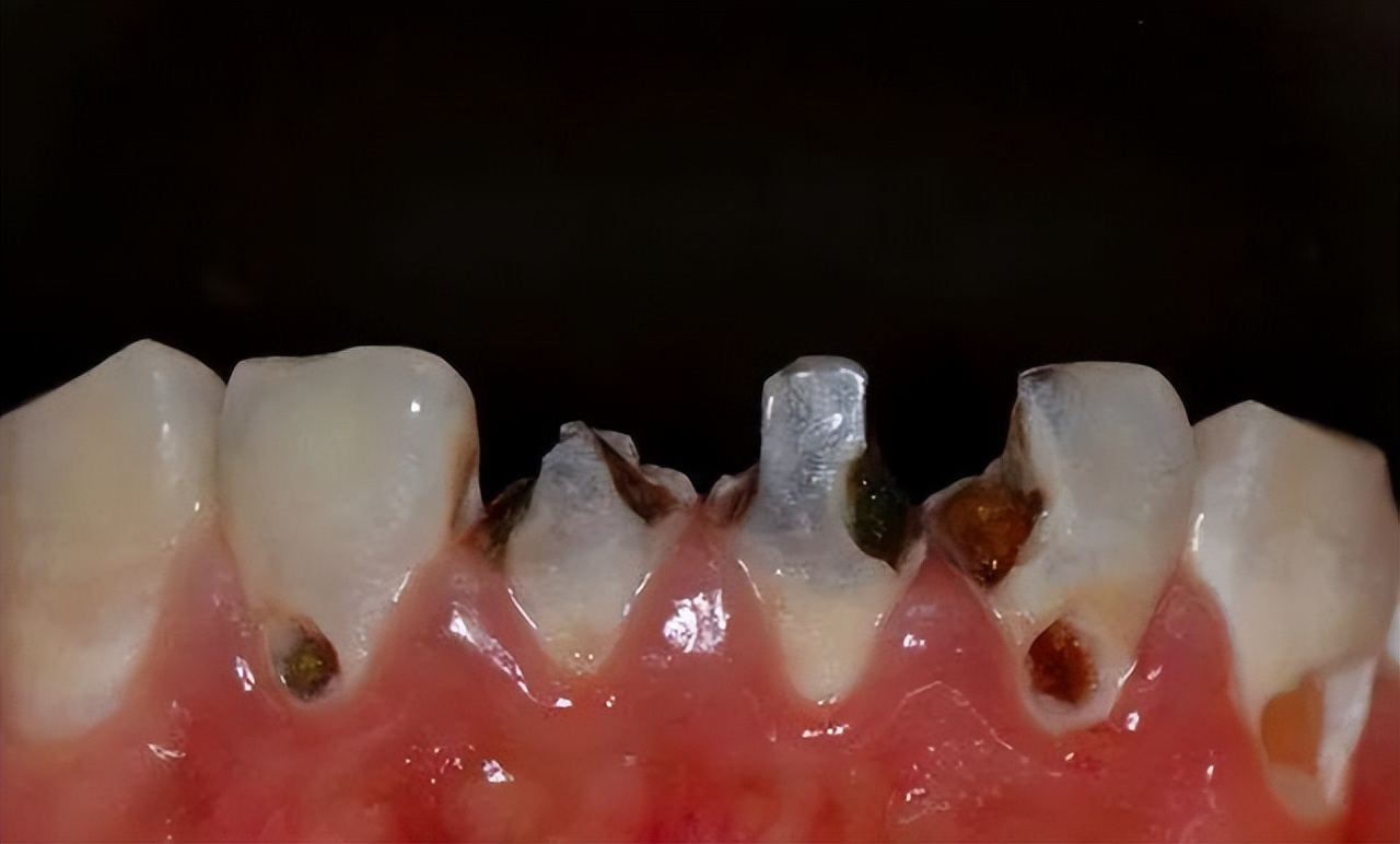 什么样的可乐牙需要治疗,健康科普温馨提示信息