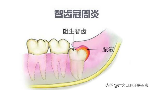 牙疼想知道自己是哪种牙疼,牙疼也算病一招解决绝对有效