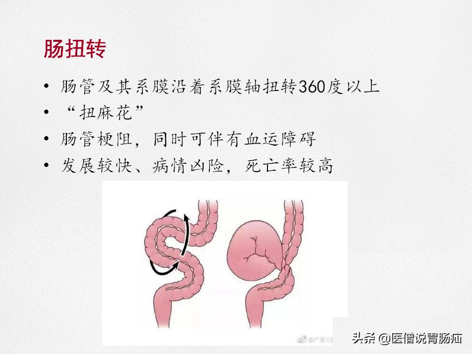 肠梗阻健康教育,肠梗阻患者的健康宣教