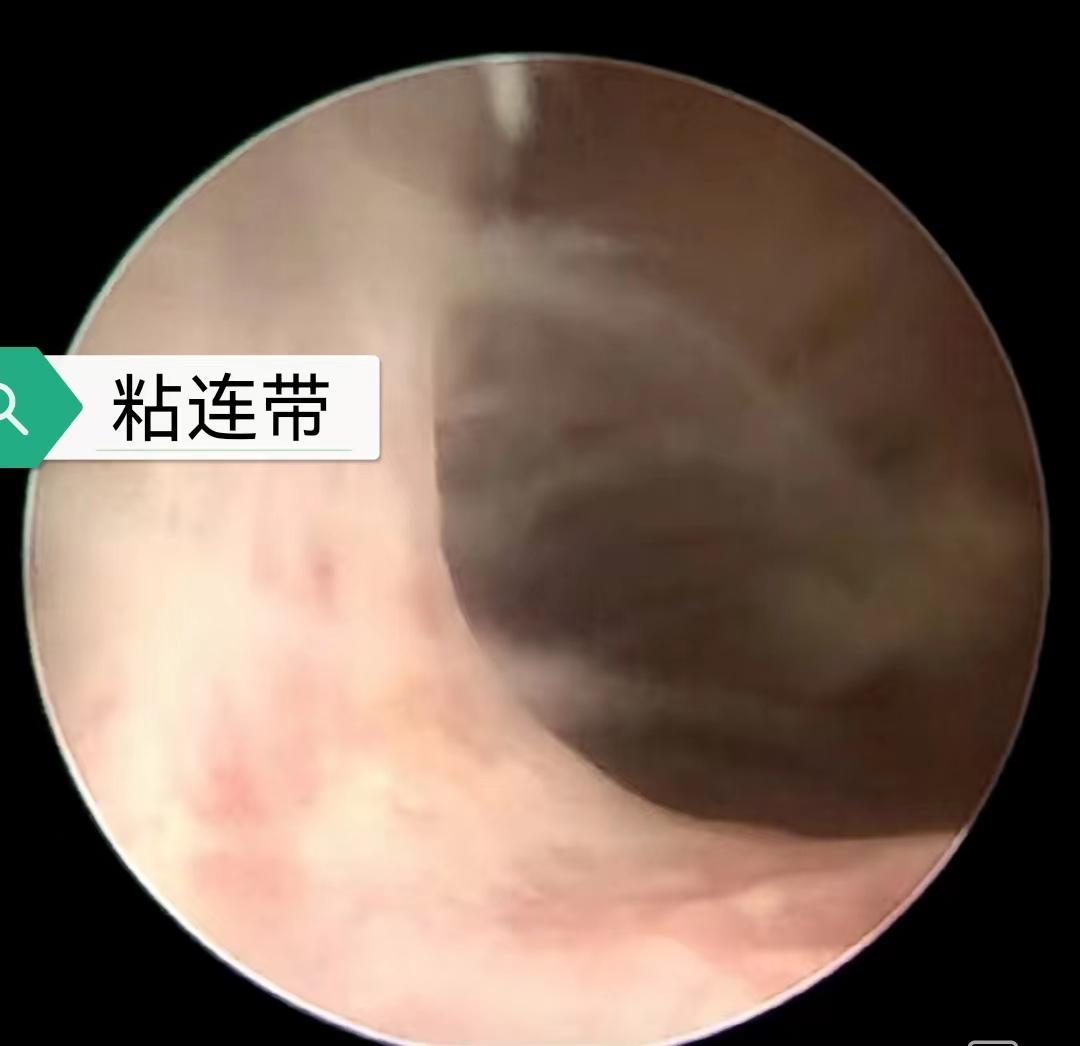 女性宫腔粘连可以做试管婴儿吗,宫腔粘连术后怀孕失败