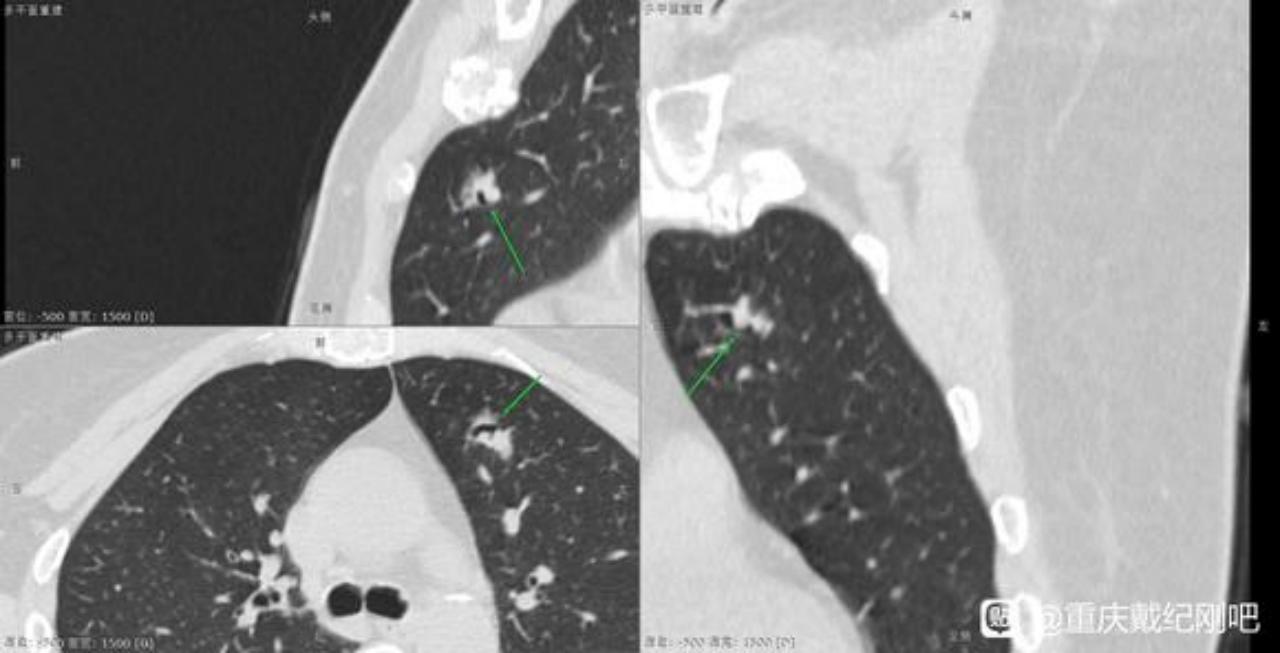3个月内磨玻璃结节,多发磨玻璃结节3个月后减少