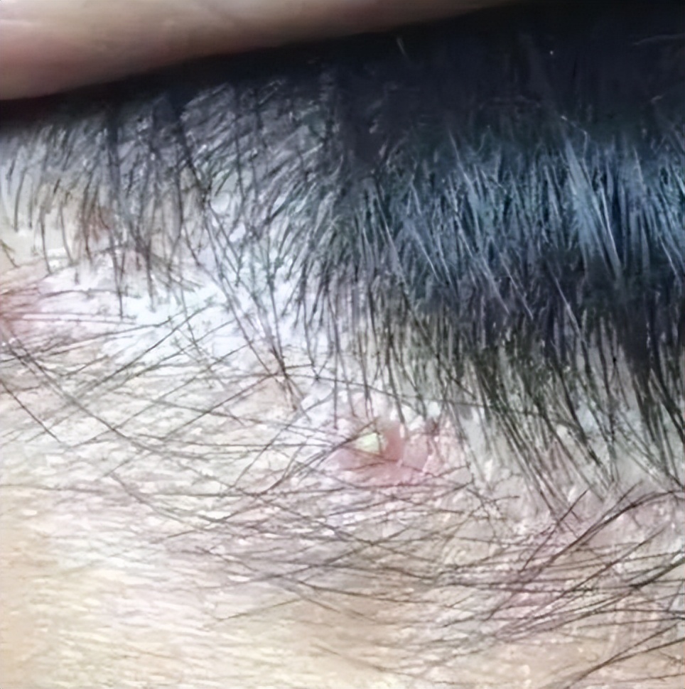 头皮上经常长脓包是怎么回事,头皮上经常长脓包和疙瘩是咋回事