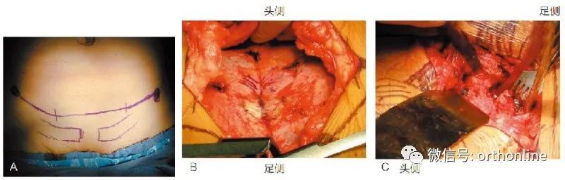 耻骨联合切开复位内固定临床操作与注意事项