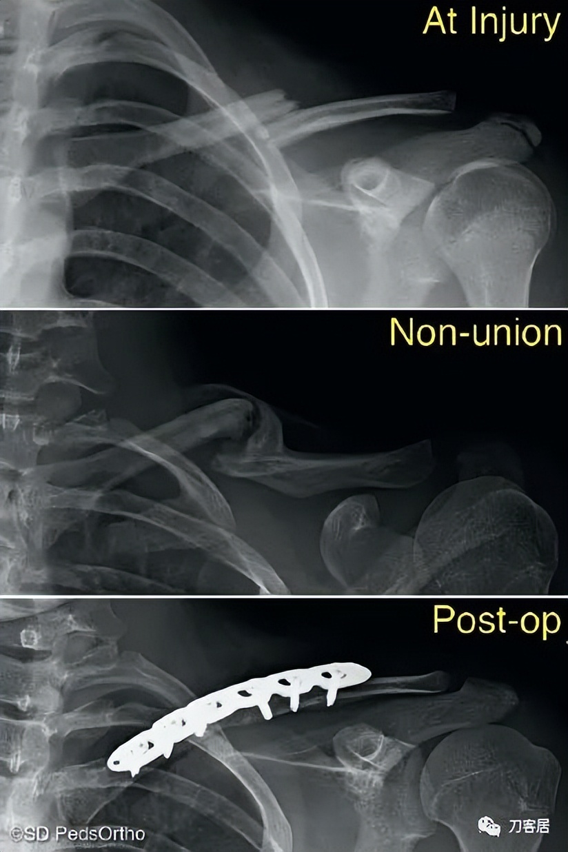 儿童锁骨骨折保守治疗的弊端,锁骨粉碎骨折错位不处理会愈合吗