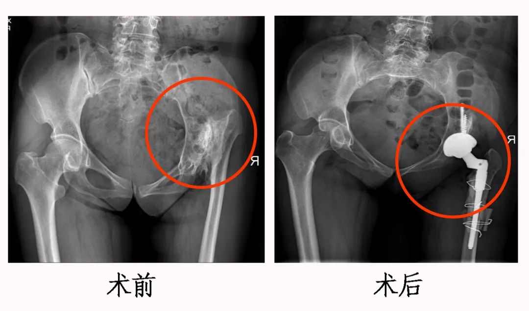 【前沿医术】3D打印，实现髋关节“私人订制”
