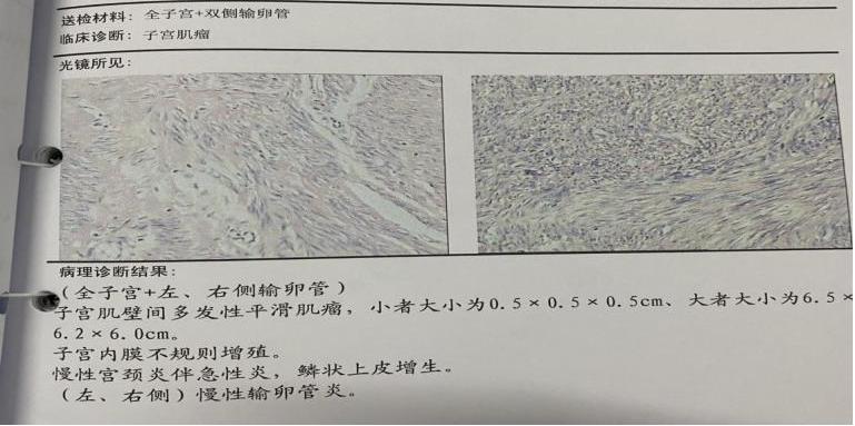 子宫肌瘤每次月经来之前腹痛,子宫肌瘤连续性出血