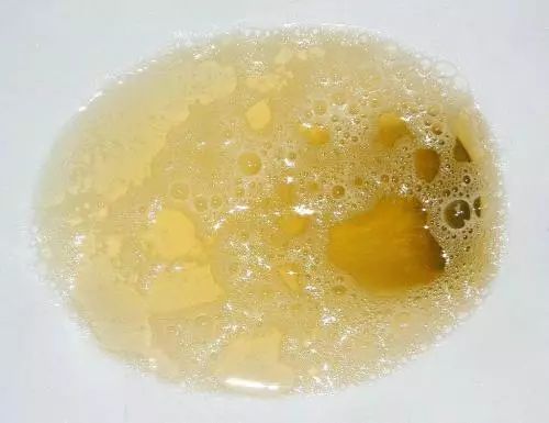 尿液出现异常是什么病,肾病的尿液会有什么症状