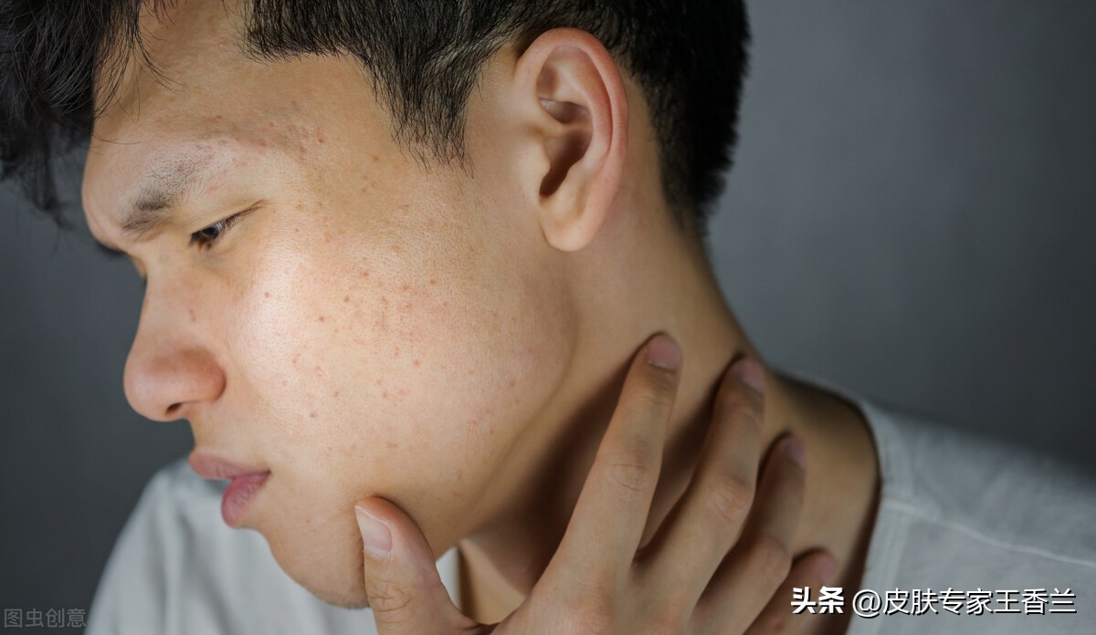 皮肤出油毛孔粗大粉刺黑头痘痘,毛孔粗大油性皮肤长痘痘怎么解决