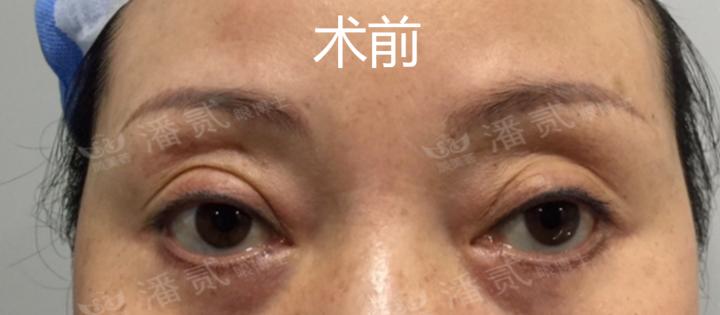 凸眼球显得眼睛大,凸眼眼窝凹陷