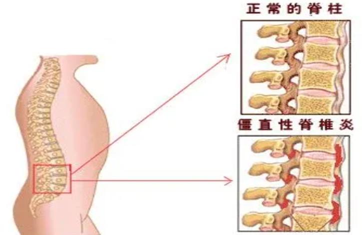 一剂中医名方,祛风除湿,活血化瘀,可治强直,肩胛腰背疼痛