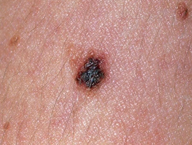 警惕这些痣可能会成瘤,哪些地方有痣代表得癌症了