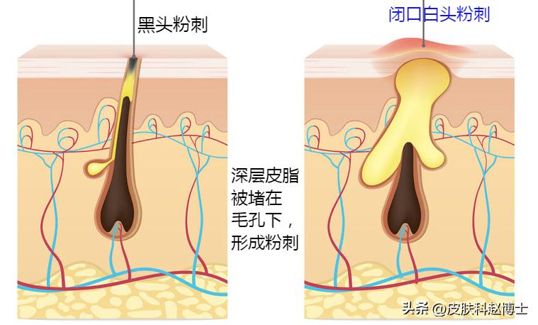 小孩脸上黑头怎么处理,脸上反反复复长黑头粉刺