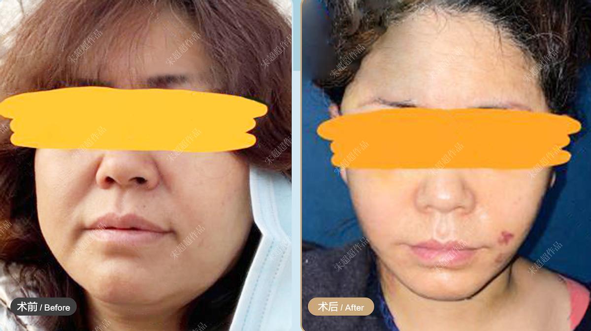 面部平整度是什么意思,怎样提高面部平整度