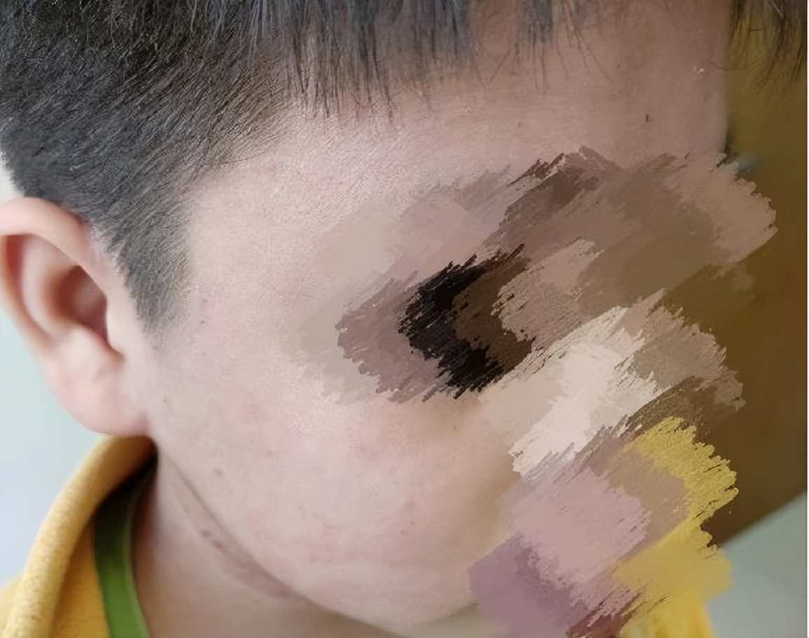 面部皮炎的症状和治疗方法,面部皮炎是怎么回事