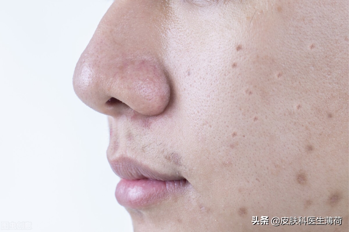 白天抗痘消炎夜晚淡化痘印,长痘就留痘印怎么去掉小妙招