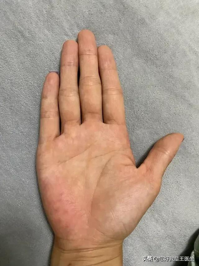 掌纹诊病学视频,掌纹诊疗