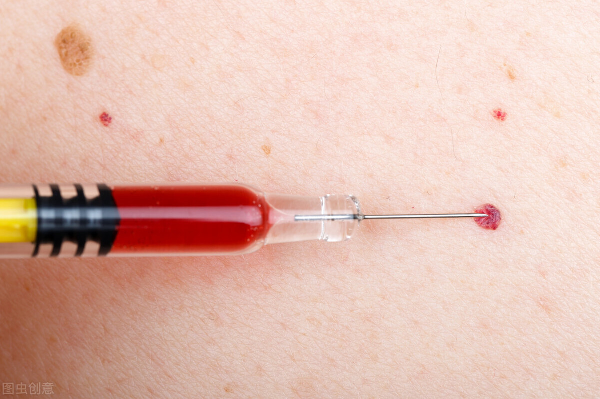 今年35岁发现皮肤长有小红痣,身上出现小红痣是不是皮肤老化了