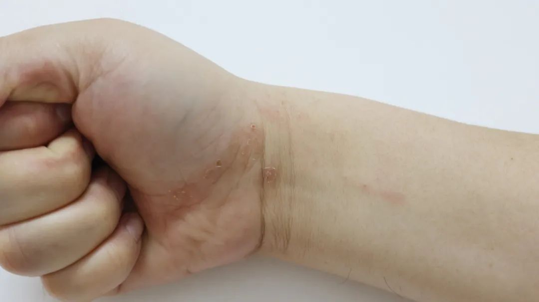 湿疹水泡很痒是怎么回事,皮肤瘙痒湿疹怎么快速治疗