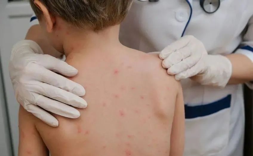 一到晚上皮肤就瘙痒荨麻疹,荨麻疹一到晚上就全身痒怎么调理