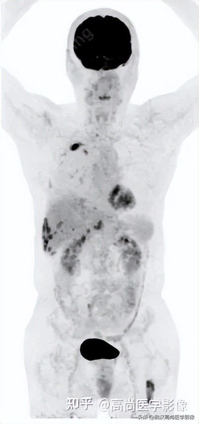 10毫米的肺结节恶性死亡率有多大,1厘米多的肺结节良性可能性多大