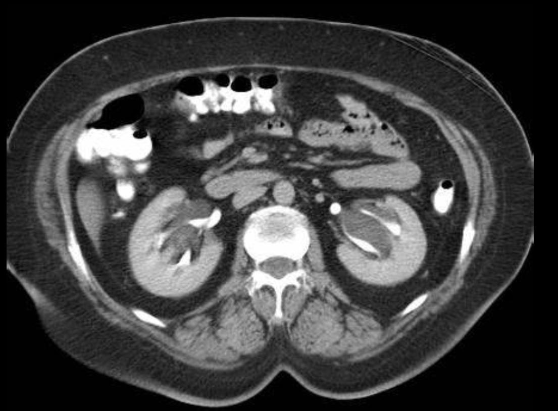什么是肾积水?查出肾积水需要治疗吗?