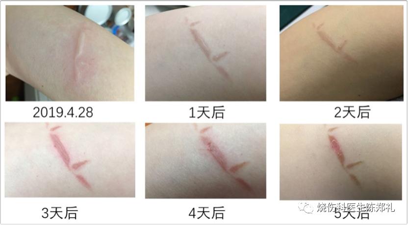 小孩在小餐桌烫伤怎么办,小朋友进厨房被烫伤了