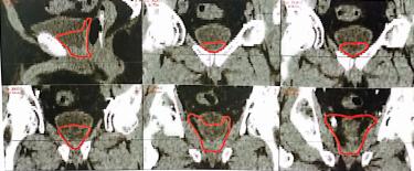 前列腺癌放疗部位,晚期前列腺放疗靶区