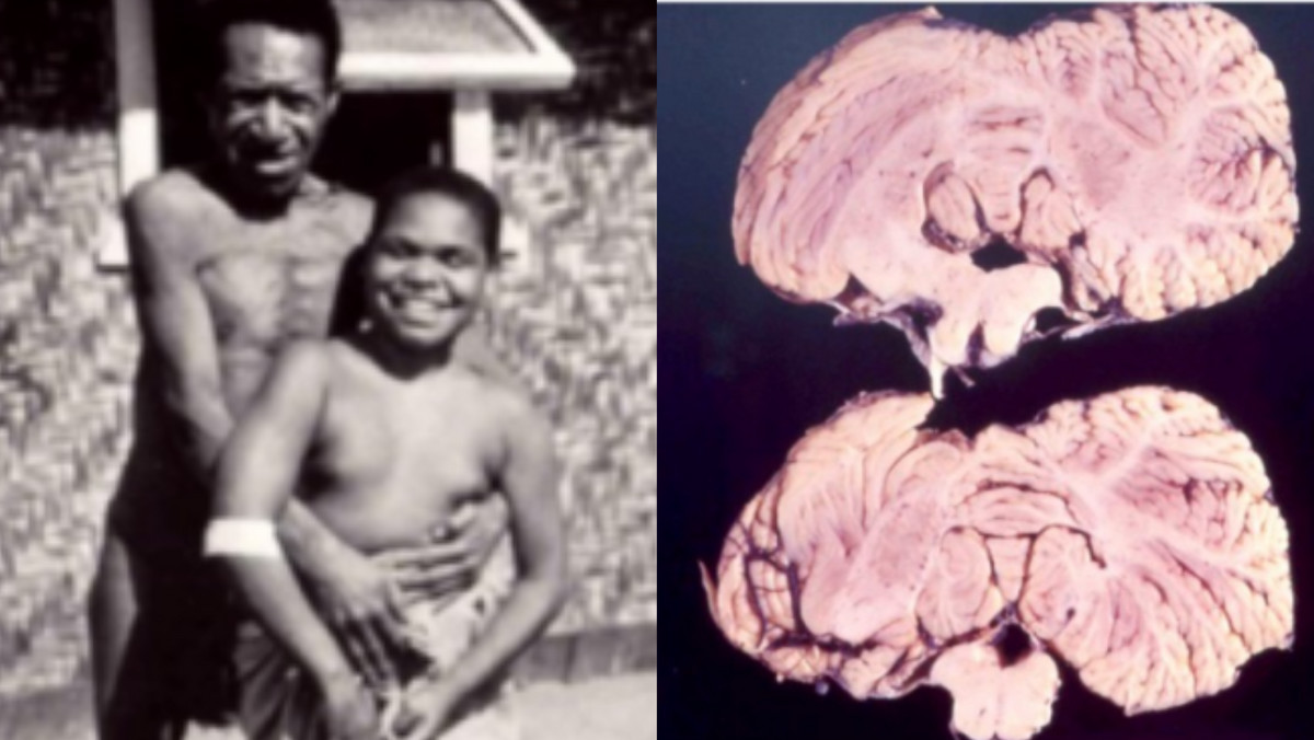 感染无药可救？烹煮杀不死的朊病毒，是上帝刻在基因的“禁令”？