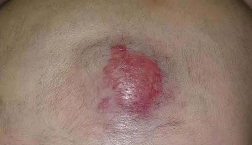 小孩哭闹血管瘤,宝宝血管瘤有什么危害