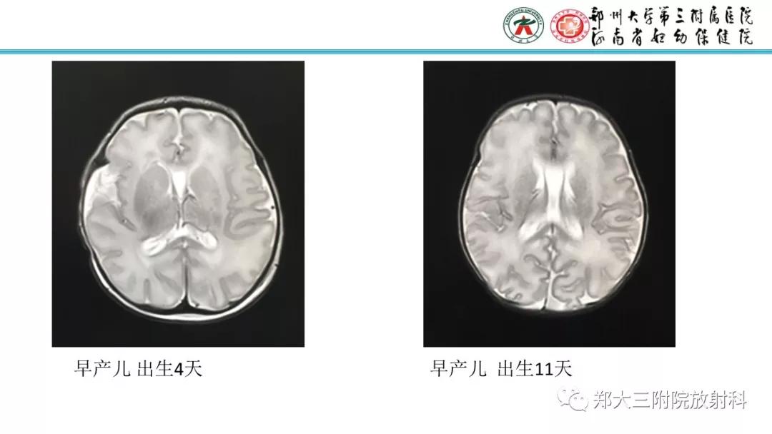 透明隔腔主要是判断什么,透明隔腔宽约10mm什么意思