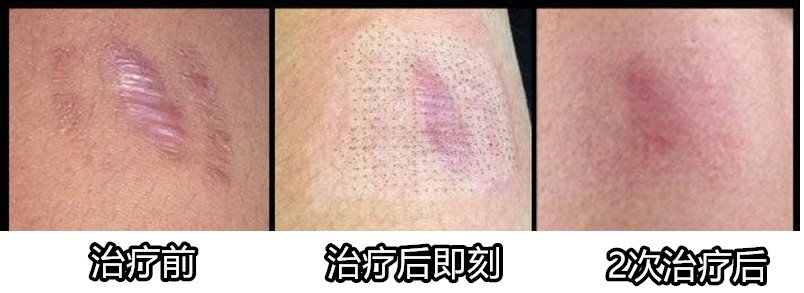 像个“小肉球”似的增生疤痕，是不是无药可救了？医生这样说：