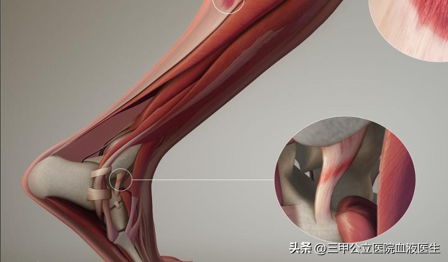 内马尔脚踝90度扭曲治疗,内马尔脚踝90度扭曲拉莫斯