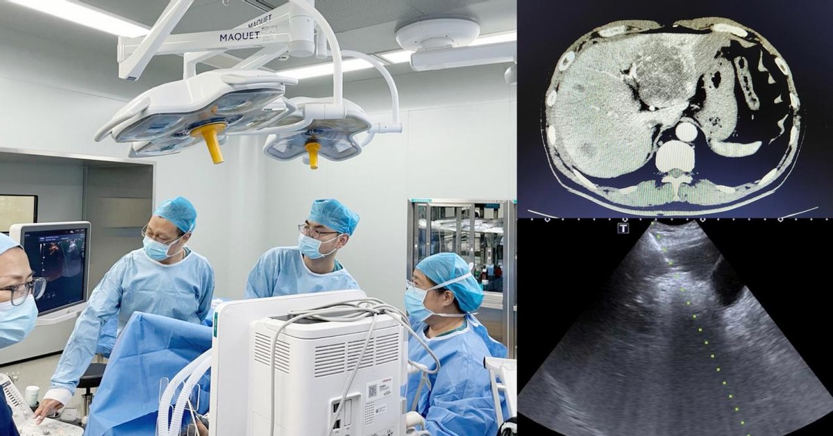 医师节系列报道|哈医大一院群力超声医学科利用超声引导下射频消融技术成功救治多位多发肝癌患者