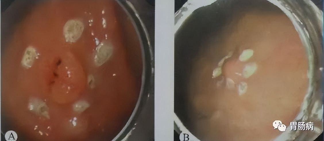 esd内镜下粘膜剥离几天可愈合,内镜下粘膜剥离术属于esd还是emr