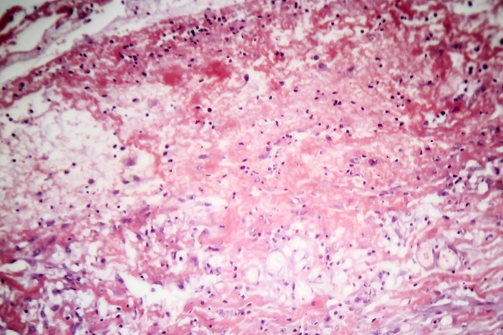 致死率100%！朊病毒无药可救且烹煮杀不死，感染后会有多恐怖？