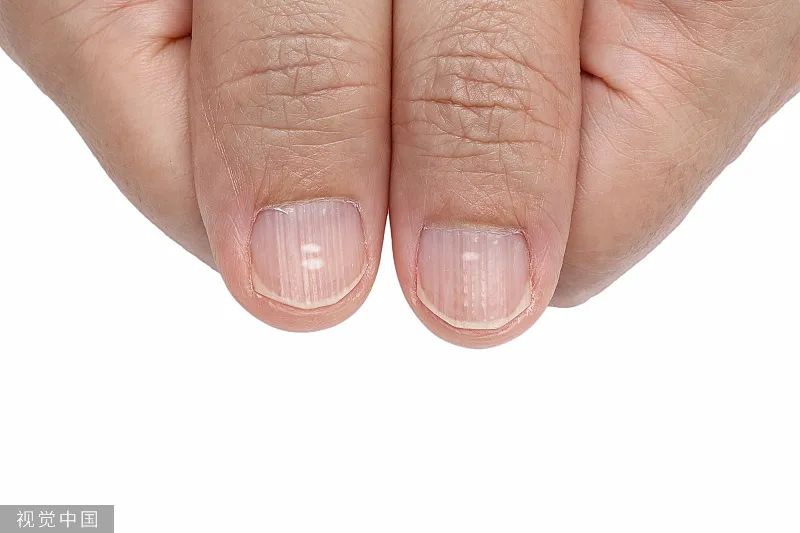 指甲出现凸起横纹当心三大疾病,指甲上有白色斑点和有倒刺