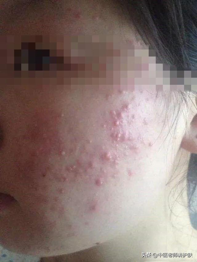 激素依赖性皮炎真相,激素依赖性皮炎的病因