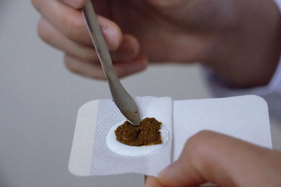 耳鼻喉科穴位贴,耳鼻喉科的三伏贴和儿科三伏贴