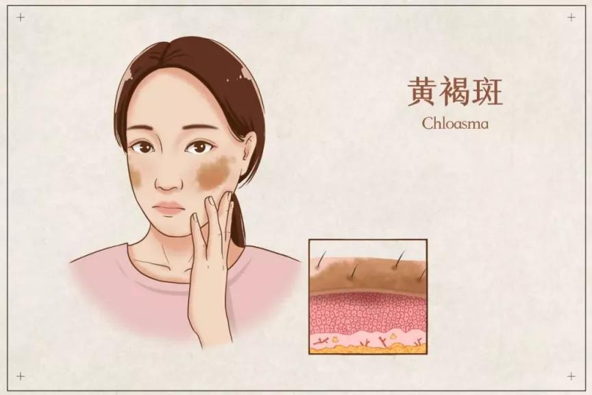 激光色沉跟晒伤是一样的吗,芭克能去除激光后的色沉吗