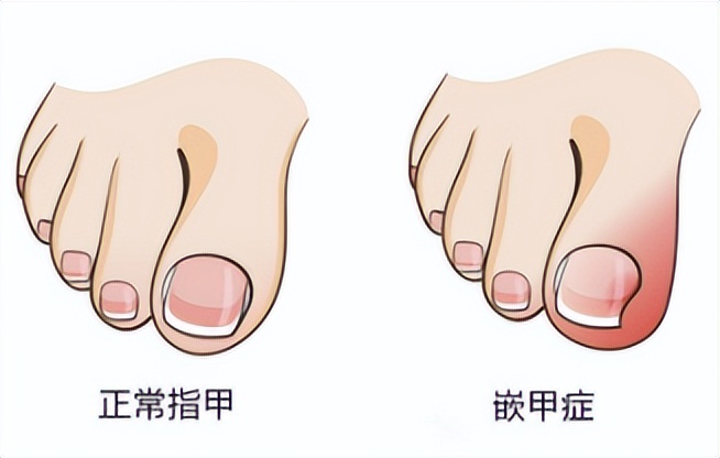 得了甲沟炎之后自己如何处理,得了甲沟炎怎么正确处理