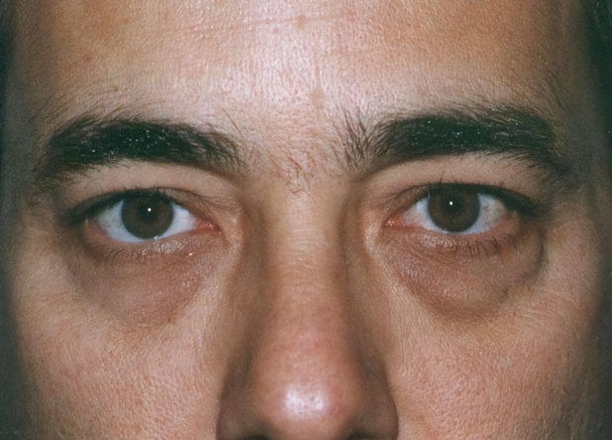 男人身上三处发黑证明肾功能很强,肾功能异常脸色发黑