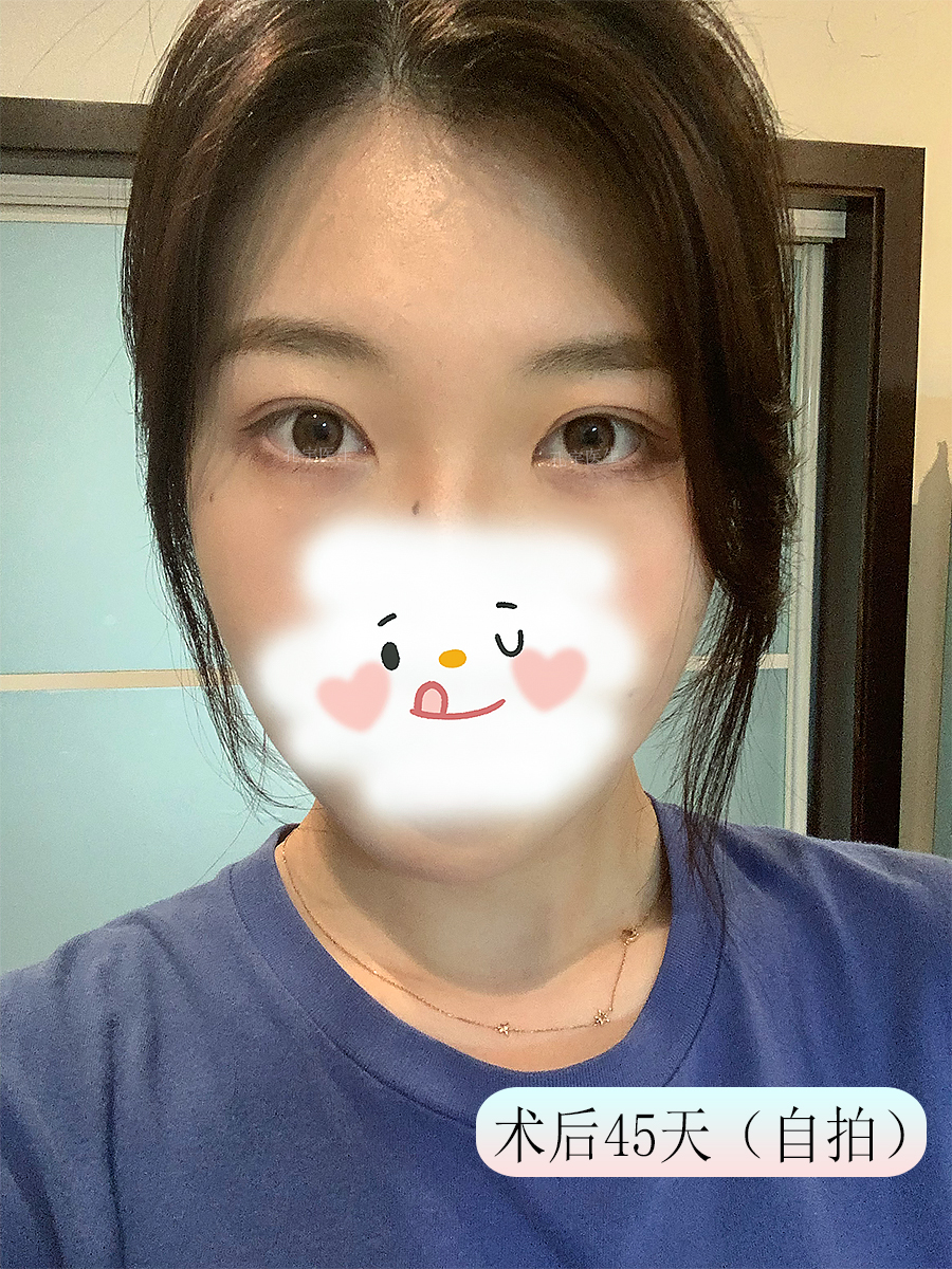 郑州修复双眼皮成功案例,郑州双眼皮修复全过程