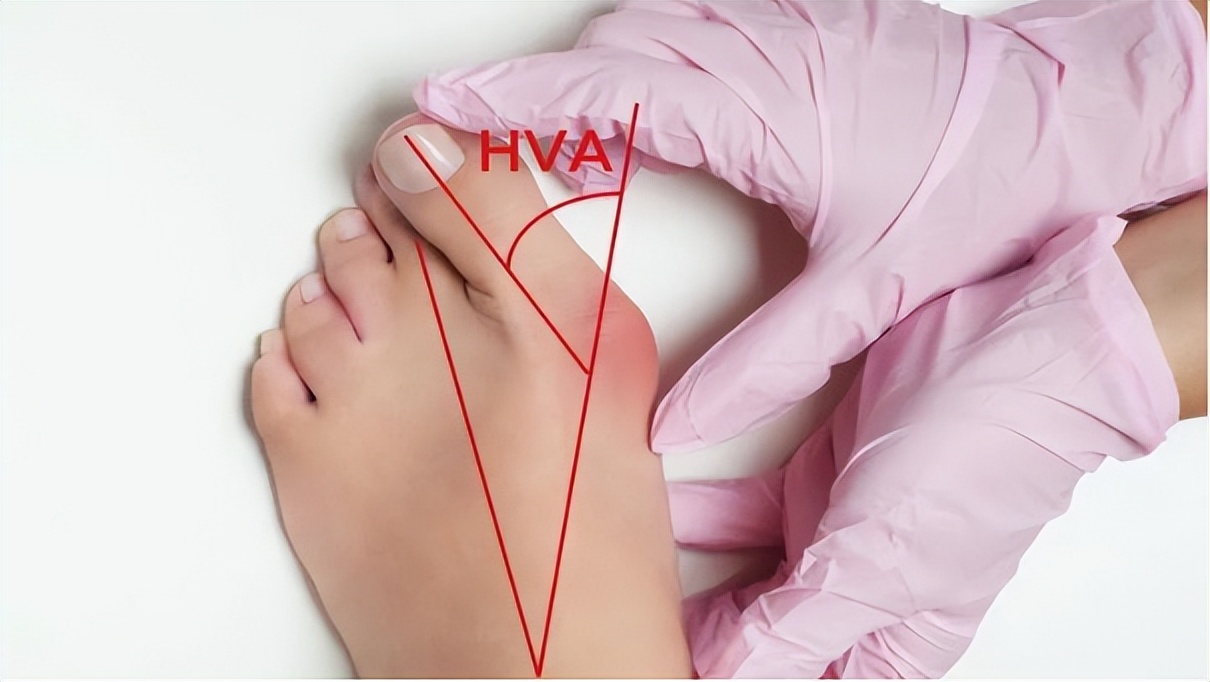 大拇脚趾往里歪怎么矫正,严重拇外翻脚趾畸形怎么办