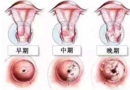 阴道炎到宫颈炎的演变及诊治策略