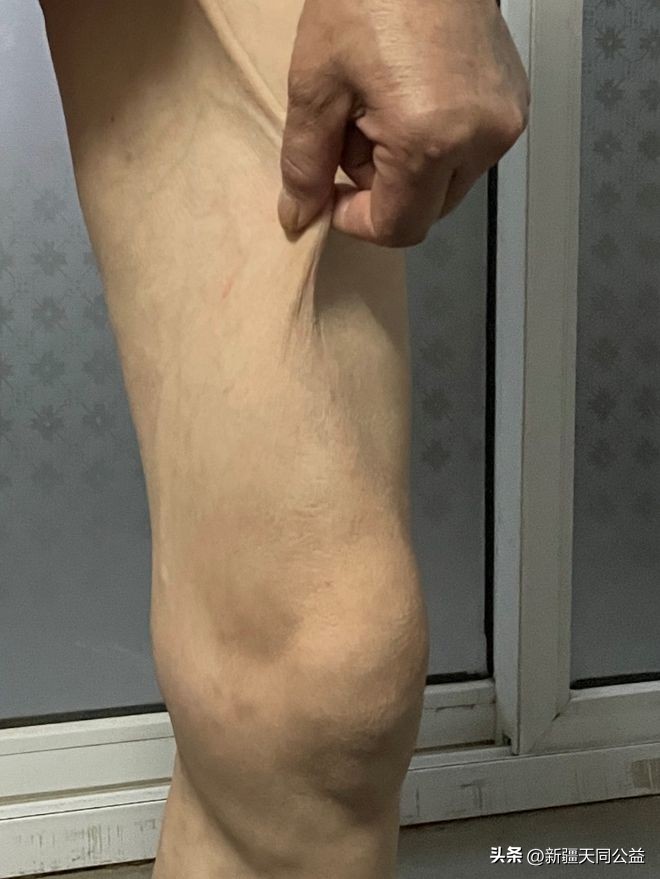 艾滋病患者的暮年，你不知道的世界！（很压抑）