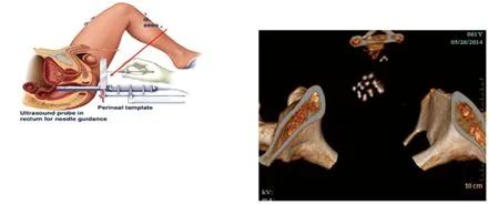 运城肿瘤专家卫毅楠教授开展新一代125-碘粒子植入术肿瘤精准治疗