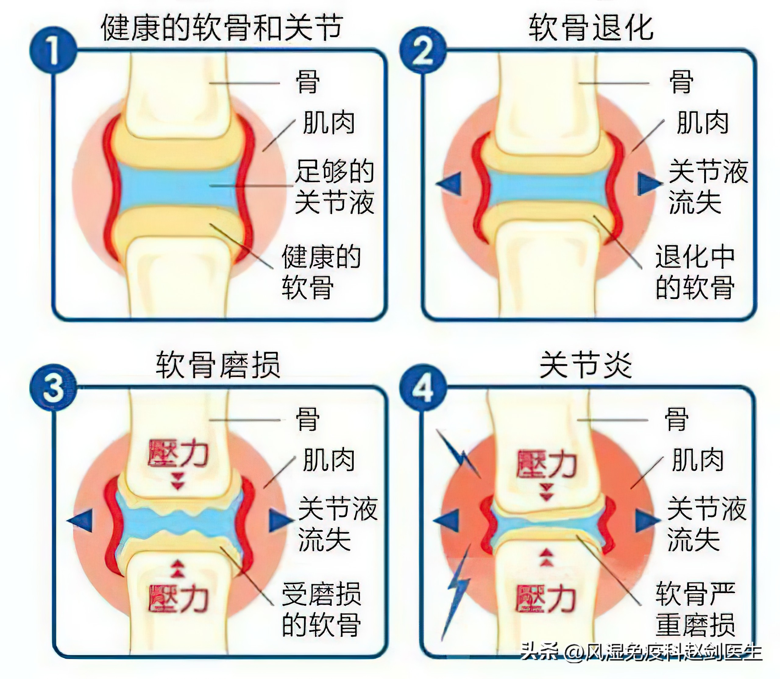 68岁膝盖疼可以补氨糖软骨素吗,退行性膝关节炎吃氨糖软骨素好吗
